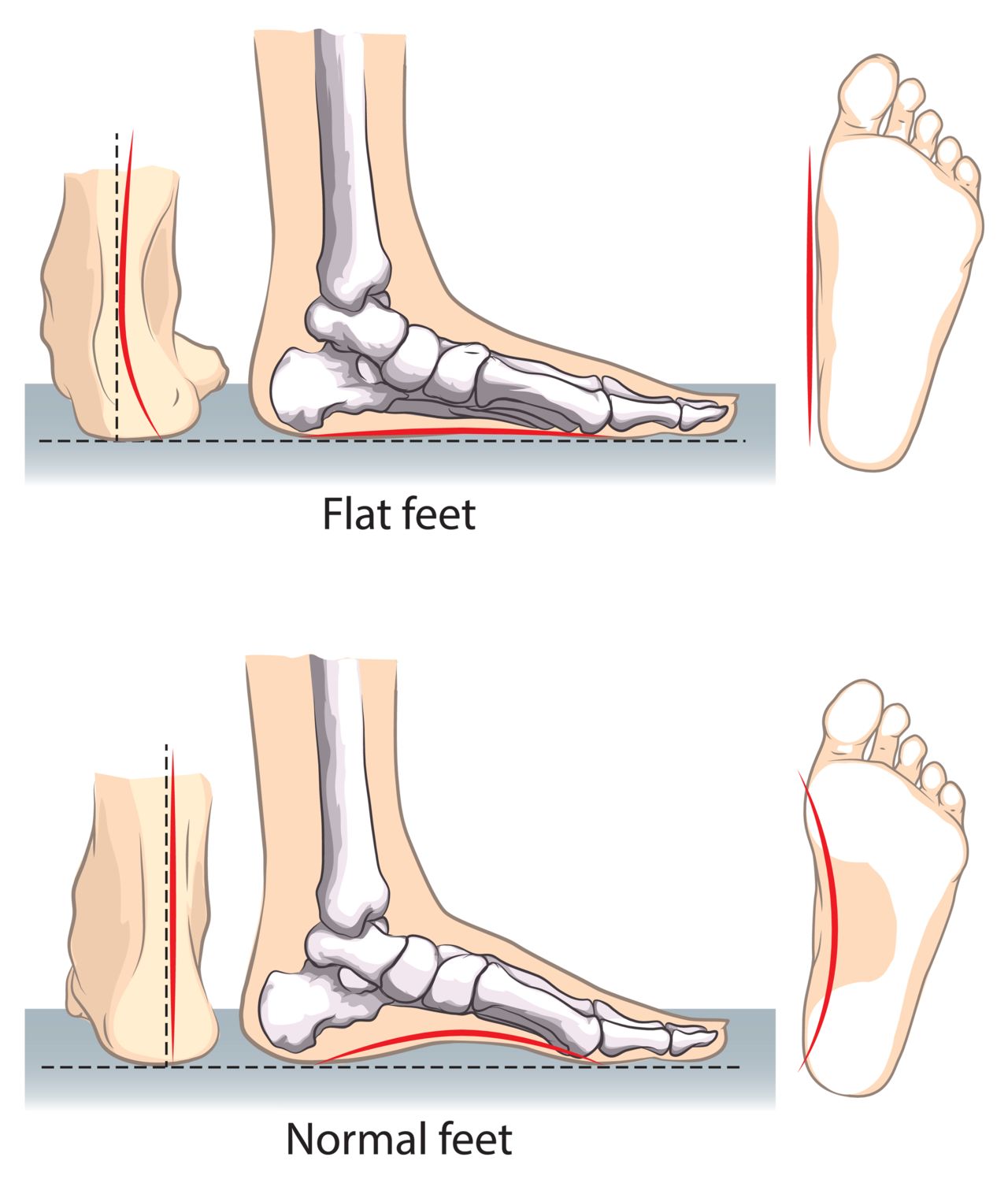 flat-feet1