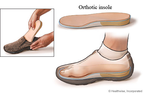 orthotic-insoles2