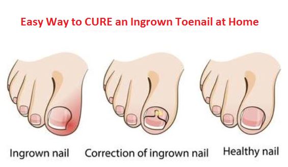 toenails