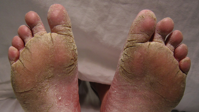 Athletes Foot Treatment - severe