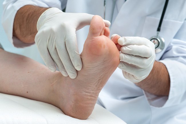 Athletes Foot Treatment - treatment