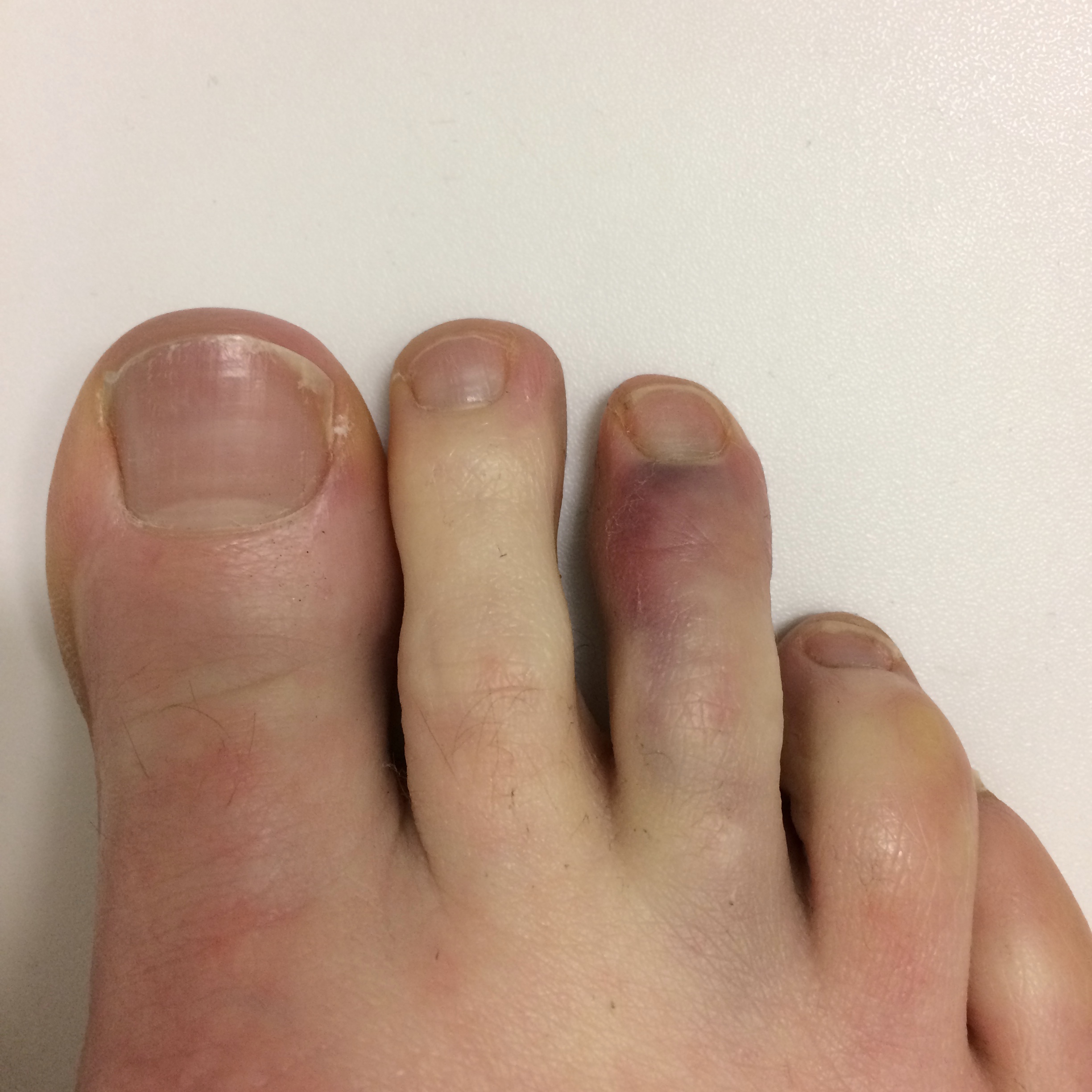 Broken_toe