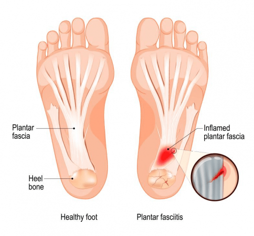 plantar fasciitis