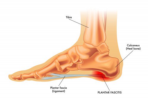 plantar-fasciitis