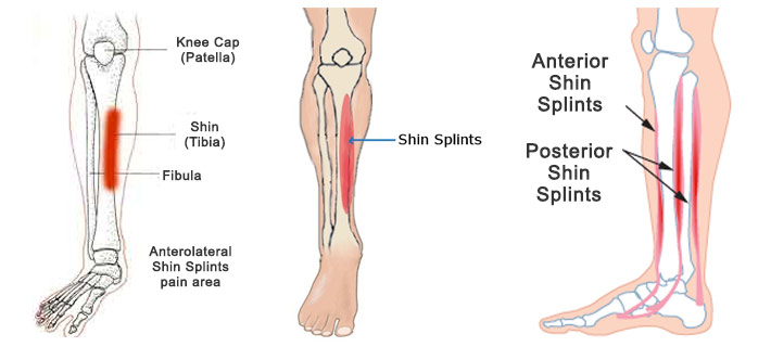 shin splint injury