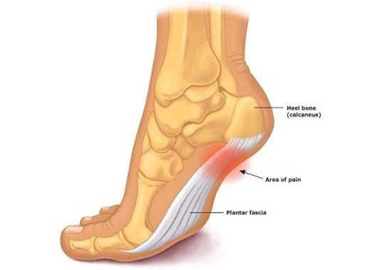 Plantar Fasciitis