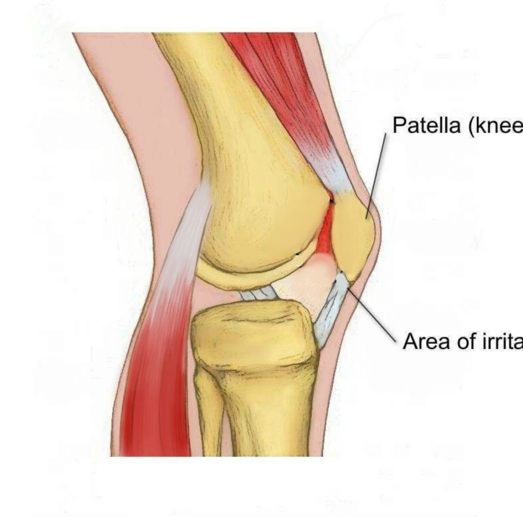 what is runner's knee