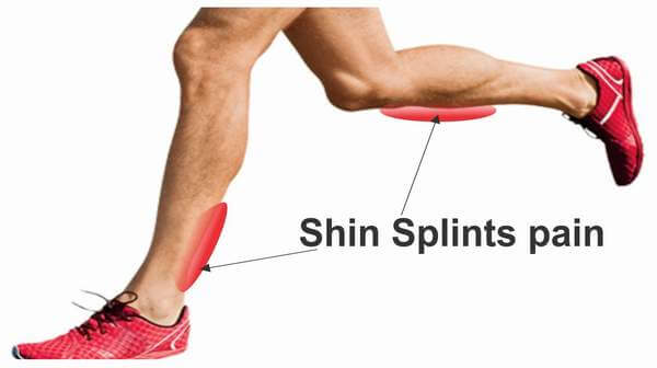 Shin Splints