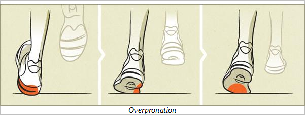 what is overpronation