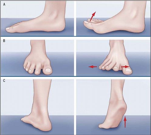 bunion exercises