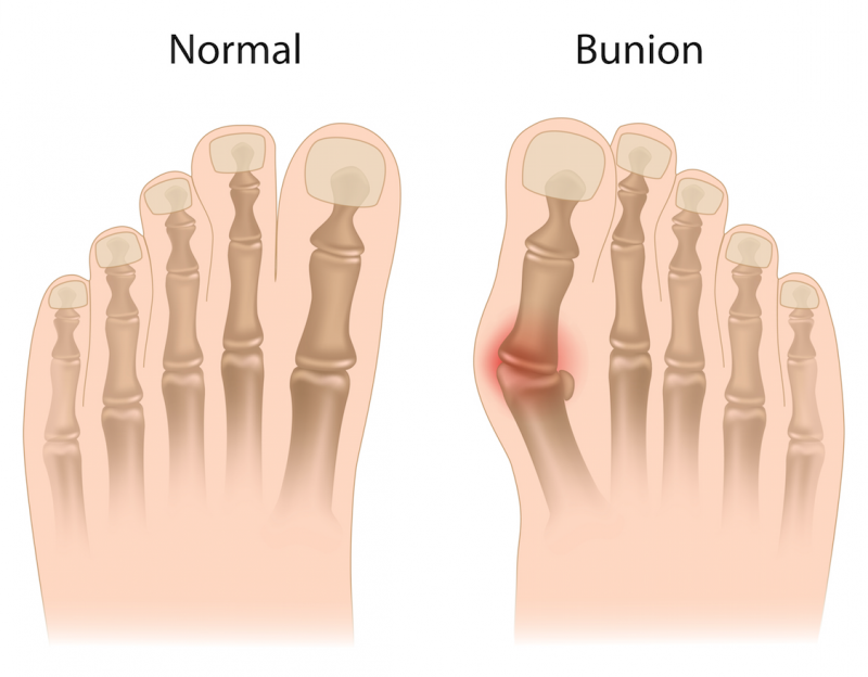 bunion prevention