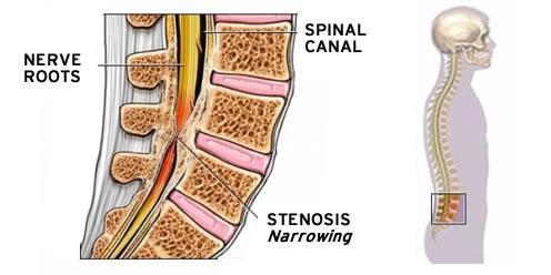 Lumbar spinal stenosis