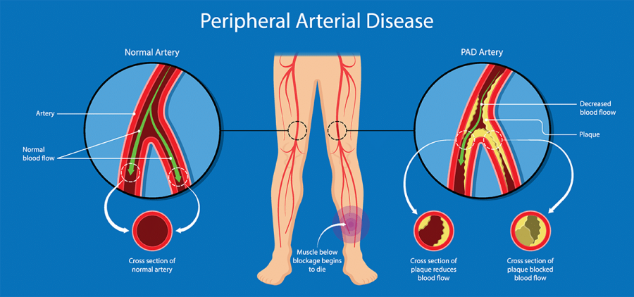 Peripheral artery disease