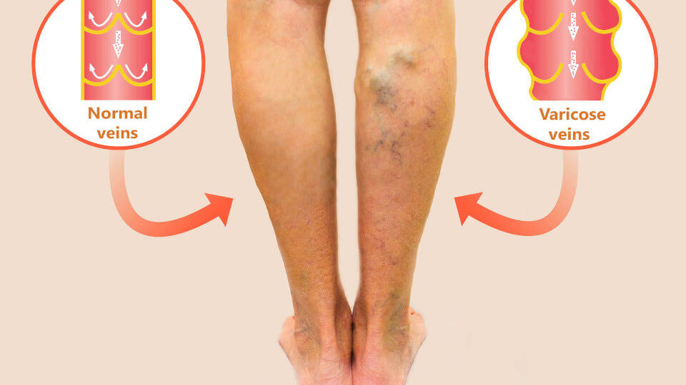 Varicose veins