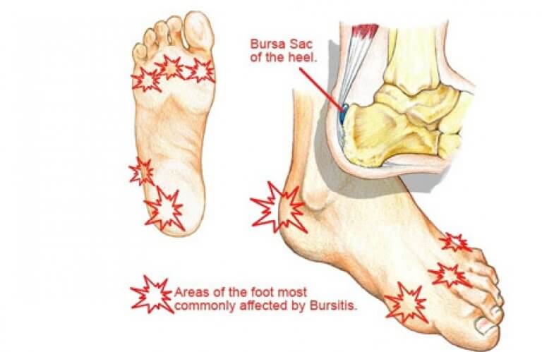 Bursitis Foot Pain: Treatment and Recovery | WalkJogRun