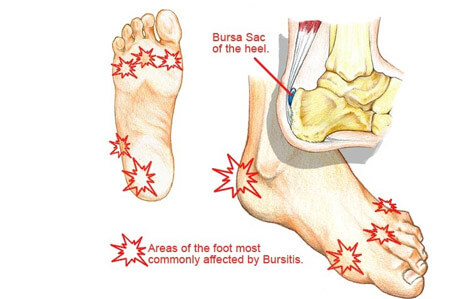 bursitis of the foot