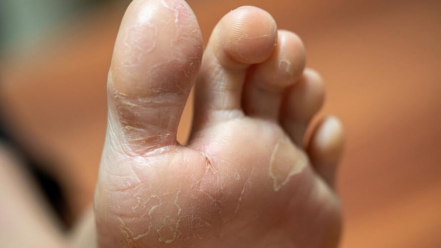 dry skin on feet