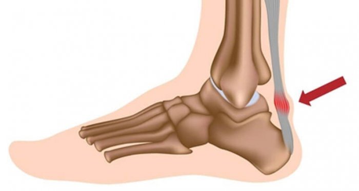 Achilles tendonitis