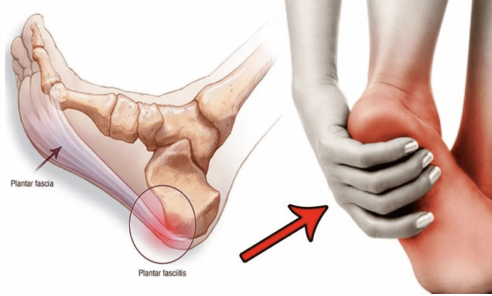 plantar fasciitis